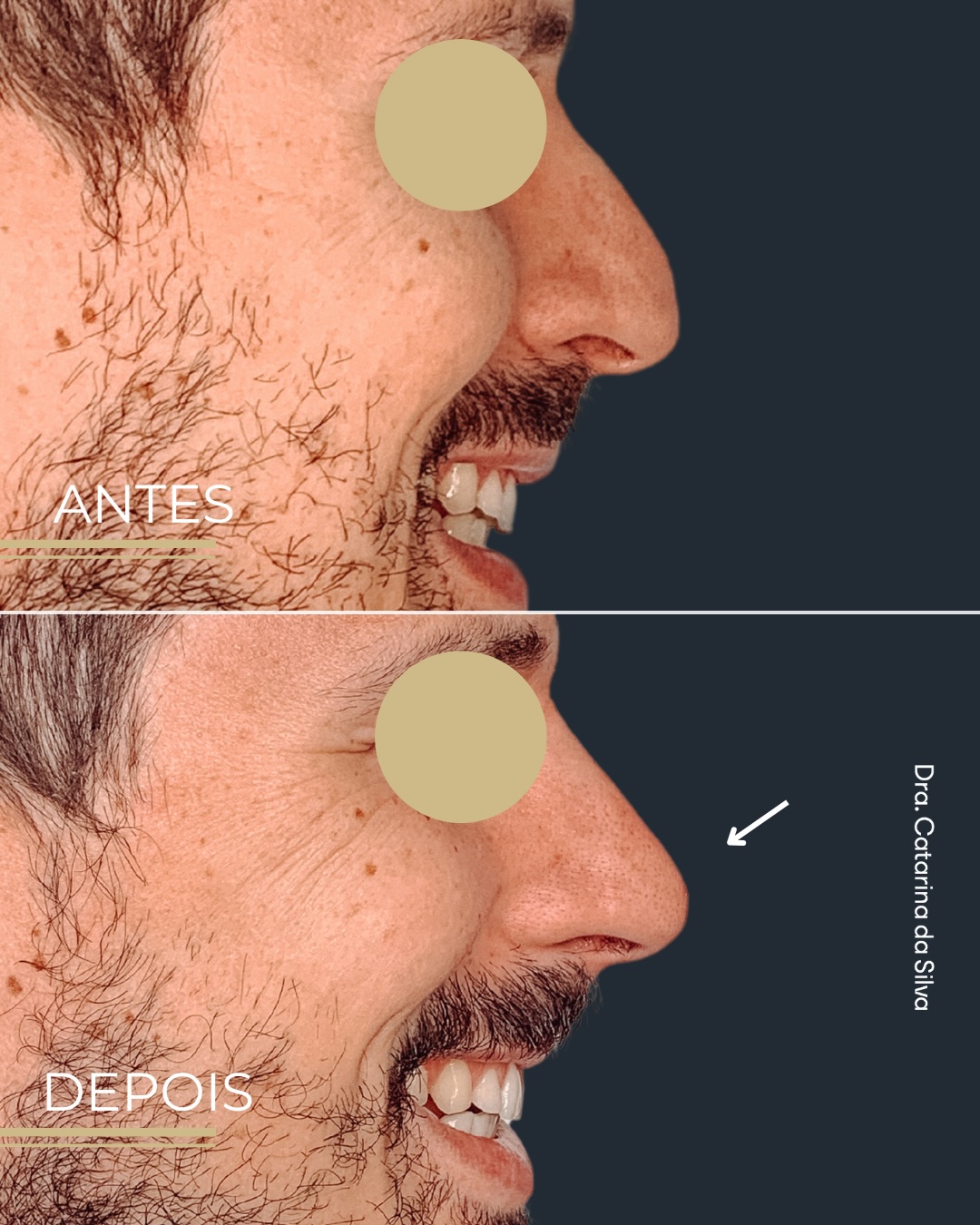 Antes e depois — Perfil nasal