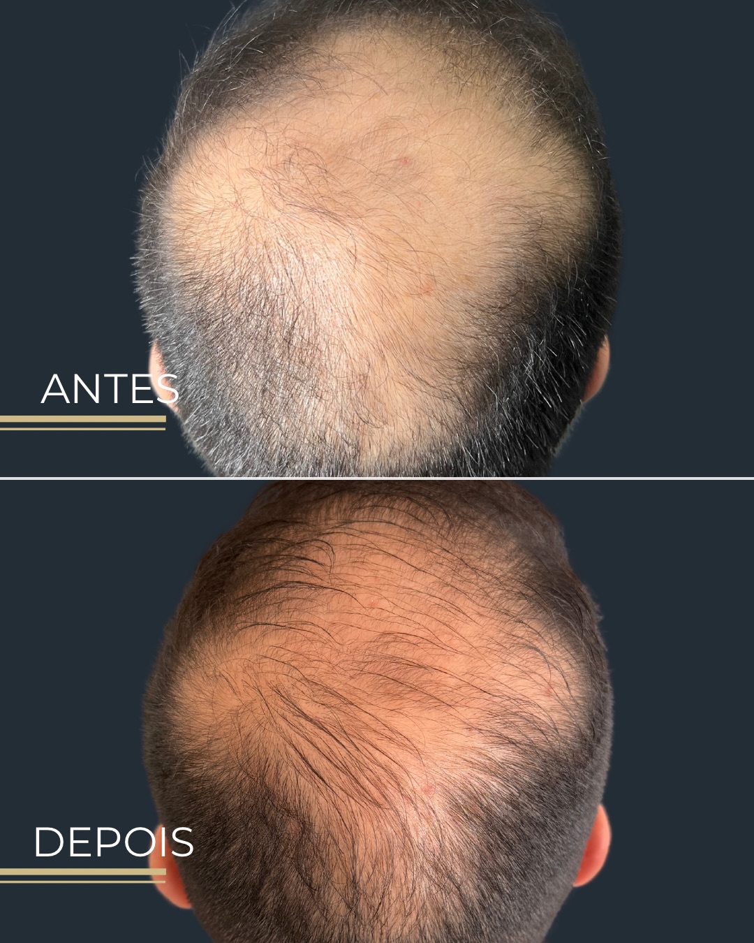 Antes e depois — Capilar