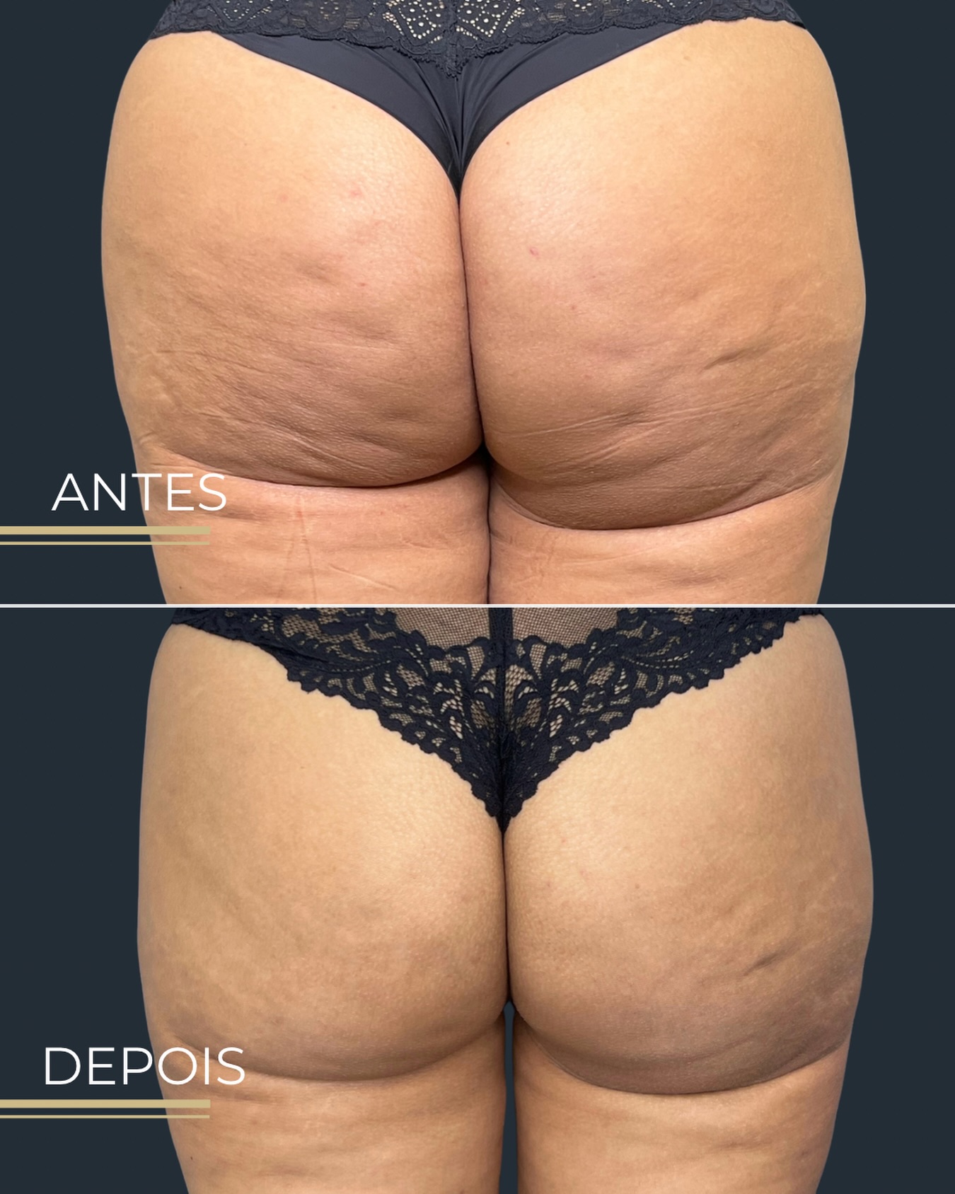 Antes e depois — Glúteos