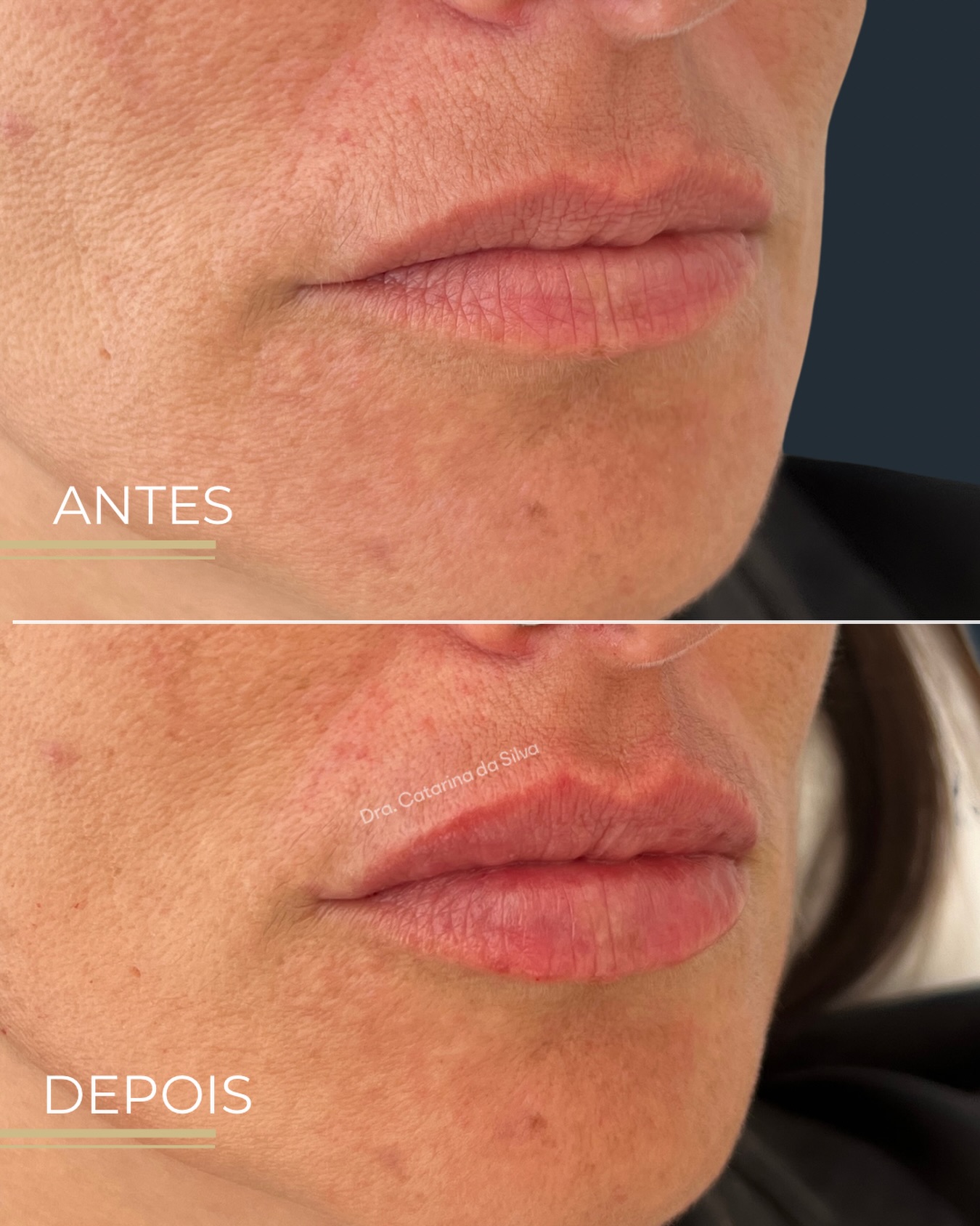Antes e depois — tratamento de lábios com ácido hialurónico