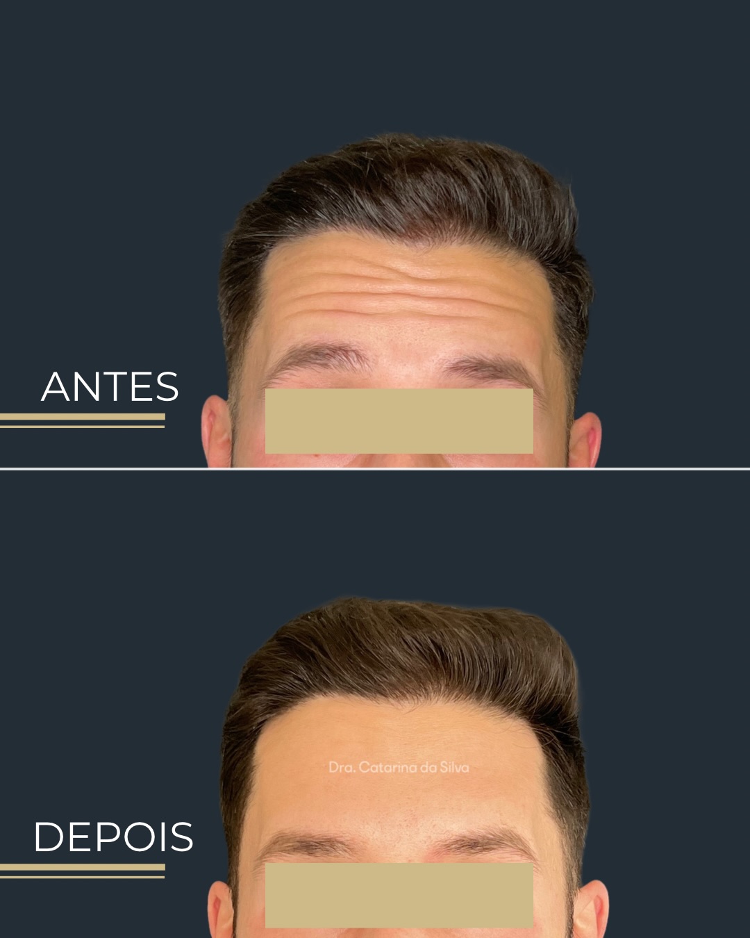Antes e depois — Testa