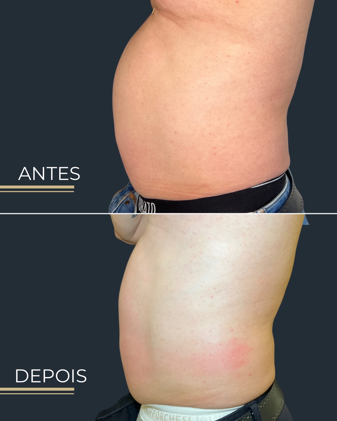 Antes e depois — Abdómen