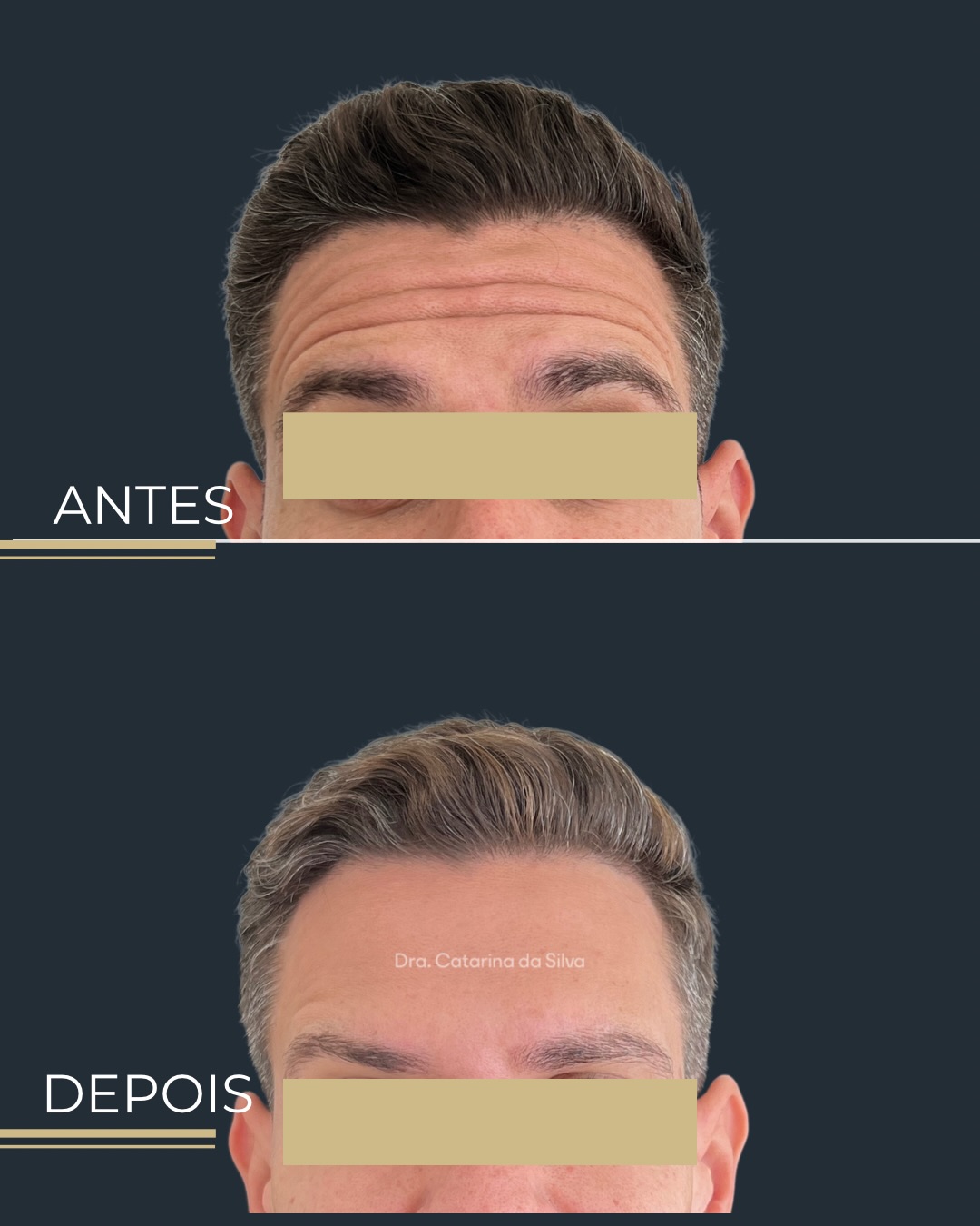Antes e depois — Testa